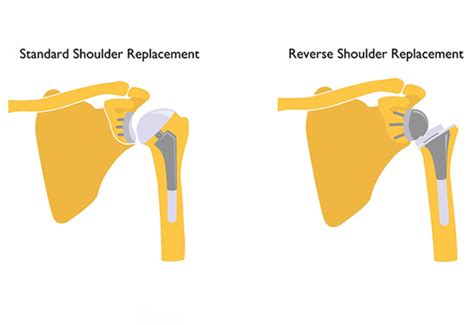 reverse total shoulder orthobullets|Reverse Total Shoulder Arthroplasty: Technique, Decision .